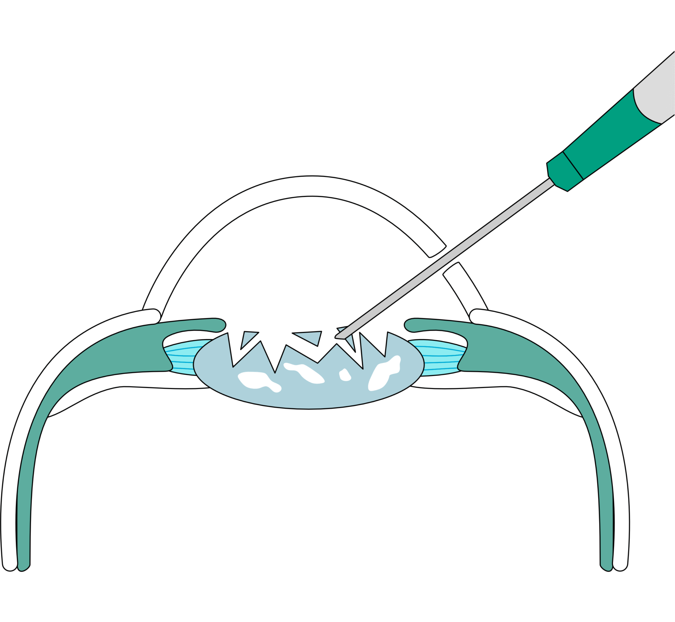 Ilustración de operación de colocación de lente intraocular