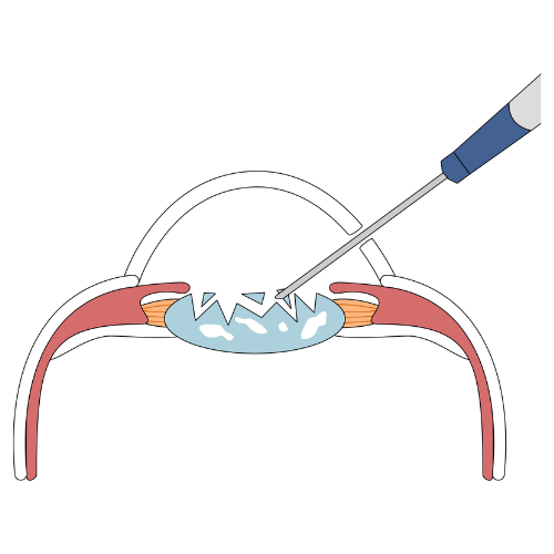 Operaciones en ojos