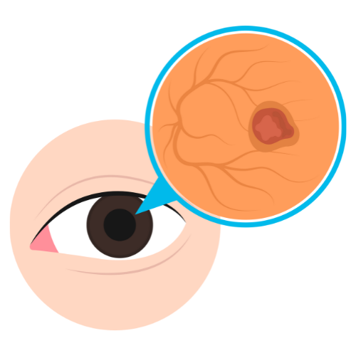 Retina